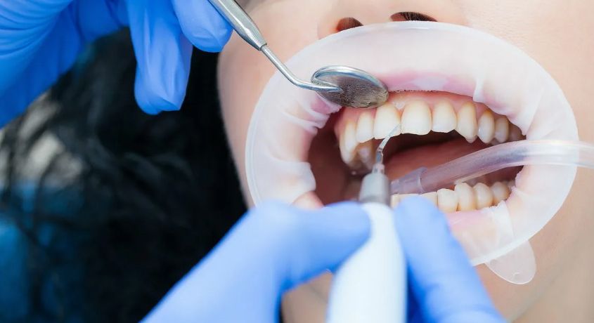 Скидка 60% на ультразвуковую чистку зубов + Air flow в стоматологической клинике 'Лэна-Дент'