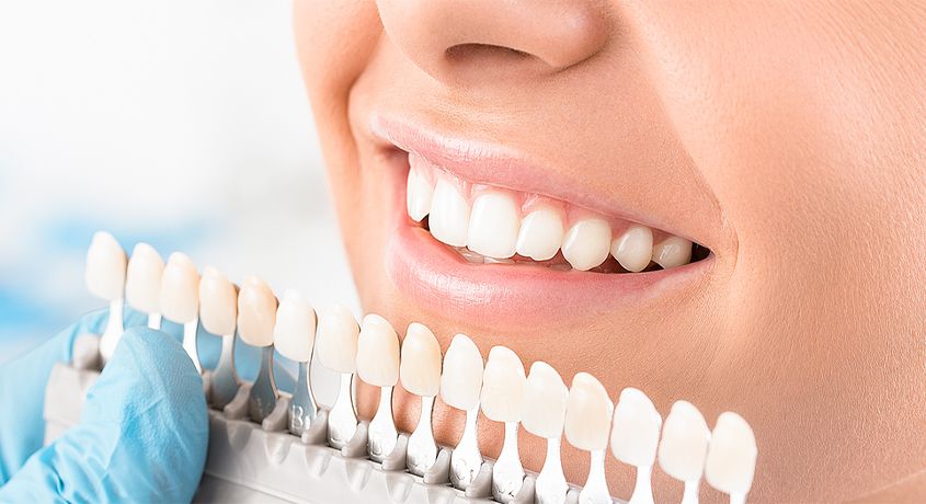 Доверьте свою улыбку профессионалам! Установка керамических виниров под ключ со скидкой 65% от круглосуточной стоматологии «Стар Дент».