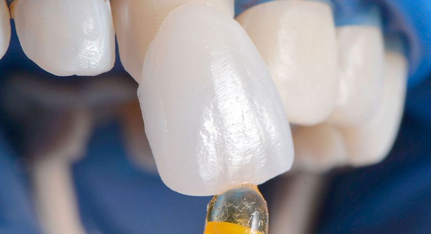 Доверьте свою улыбку профессионалам! Установка керамических виниров под ключ со скидкой 65% от круглосуточной стоматологии «Стар Дент».