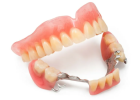 Бюгельный протез на 4 зубах