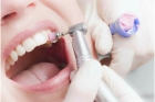 Профессиональная гигиена чистка зубов