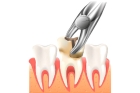 Удаление однокоренного зуба