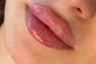 Увеличение губ Philos