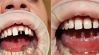 Эстетическая коронка на зуб