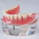 Фиксация съемных зубных протезов