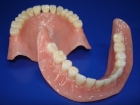 Съемный протез на жевательные зубы