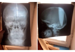 Рентгенография всего черепа,  глазницы  и канала зрительного нерва