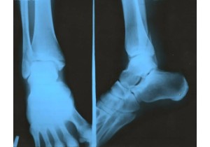 Рентгенография голеностопного сустава и лодыжки