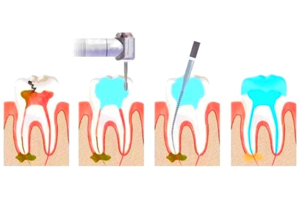 Лечение пульпита 2-канального зуба