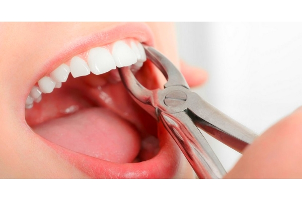 Удаление подвижной стенки зуба