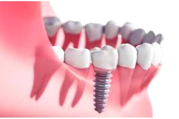 Зубная коронка на имплант