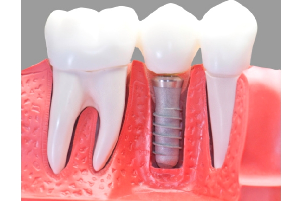 Протезирование верхних зубов на имплантах