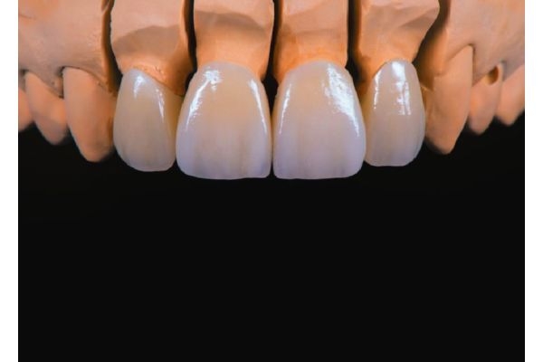 Восстановление зуба коронкой керамической прессованной