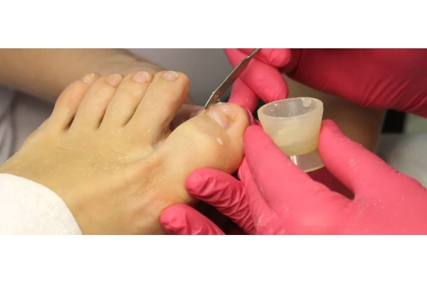 Коррекция протезирования при вросшем ногте 