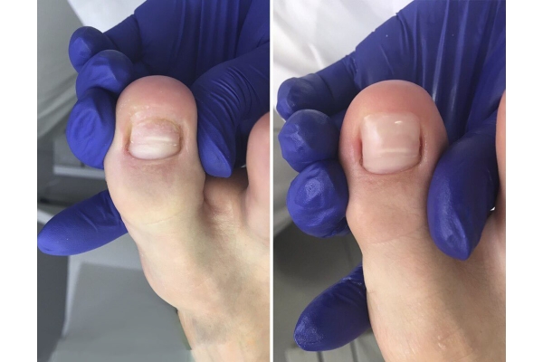 Протезирование ногтевой пластины