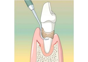 Маргинальная повязка в области одного зуба