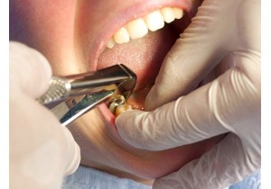 Сложное удаление 8 зуба (нижняя челюсть)