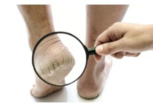 Лечение трещин на ногах