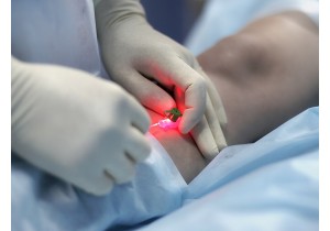 Эндовенозная лазерная облитерация (ЭВЛО)