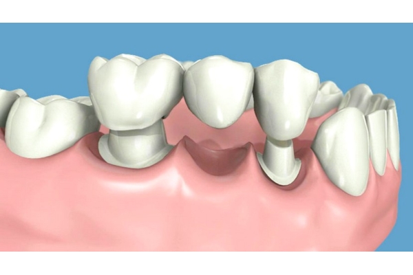 Зуб литой в мостовидном протезе