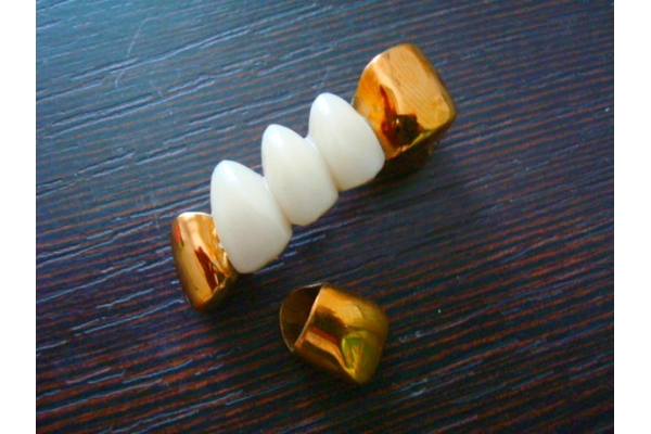 Зуб литой с пластиковой фасеткой с напылением