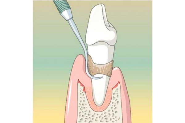 Маргинальная повязка в области одного зуба