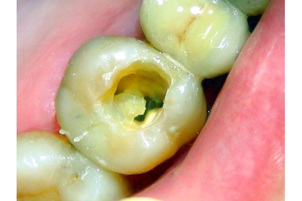 Раскрытие полости зуба -1 канала