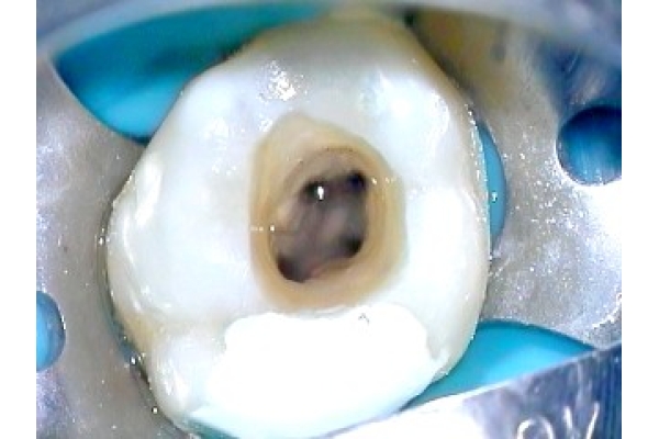 Раскрытие полости зуба (4 канала)