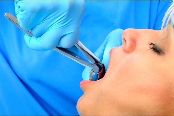 Сложное удаление постоянного зуба в стадии обострения воспалительного процесса