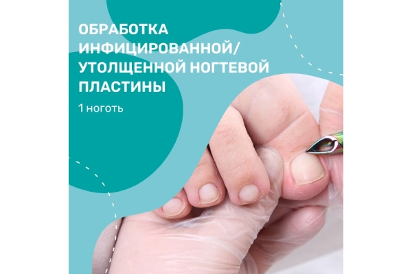 Обработка инфицированной/утолщенной ногтевой пластины (1 ноготь)