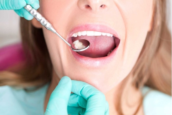Пломбирование 3 канального зуба