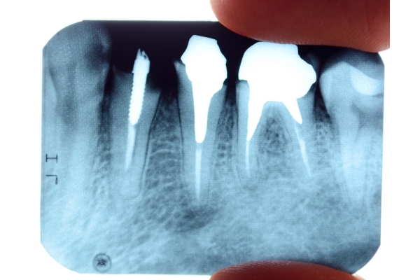 Удаление разрушенного зуба