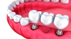 Металлокерамический зуб в мостовидном протезе с опорой на имплант (промежуточный)