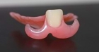 Эстетическая съёмная пластинка 1-3 зуба