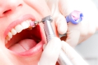 Удаление зубного камня ультразвуком (вся полость рта)