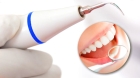 Удаление зубного камня ультразвуком (1 зуб)