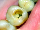 Раскрытие полости зуба -1 канала