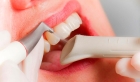 Удаление зуба с использованием УЗИ аппарата