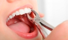 Удаление 1 корневого зуба