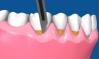 Гингивотомия 1 зуба
