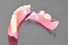 Приварка второго и третьего зуба  (1 единица)