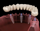 Имплантация зубов одномоментно