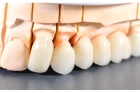 Коронки из циркония в стоматологии