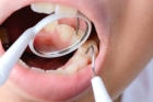 Перкуссия зубов 