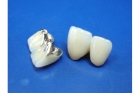 Восстановление зуба коронкой металлокерамической