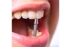 Рассрочка на имплантацию зубов