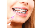 Гигиена полости рта ортодонтическая