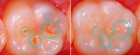 Герметизация фиссур 1 зуба