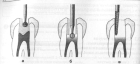 Раскрытие полости зуба (3 канала)