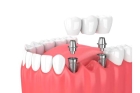 Имплант зуба под ключ